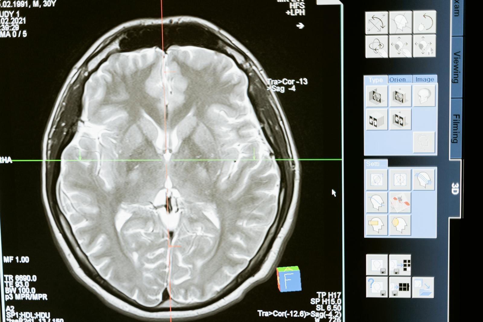 A brain MRI scan open on a radiology workstation screen